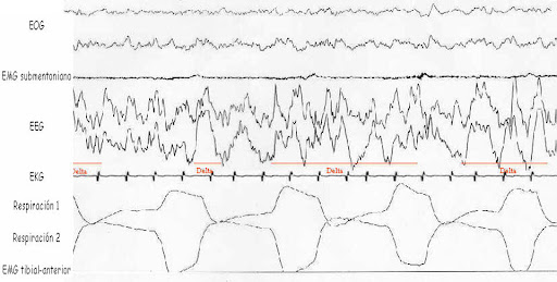 Actividad cerebral durante sueños lúcidos EEG