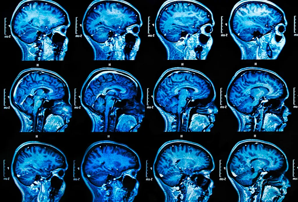 Cambios Cerebrales por Meditación